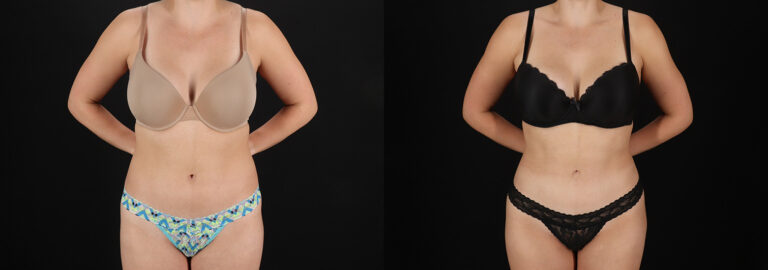 Liposuction Before and After Photo by Dr. Erika A. Sato in Houston TX
