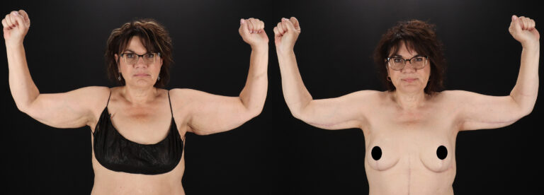 Arm Lift Before and After Photo by Dr. Erika A. Sato in Houston TX