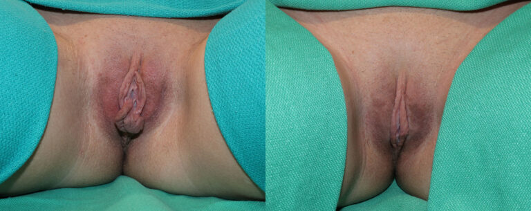 Labiaplasty Before and After Photo by Dr. Erika A. Sato in Houston TX