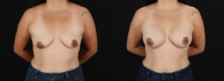 Breast Augmentation Before and After Photo by Dr. Erika A. Sato in Houston TX
