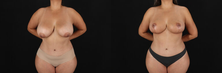 Breast Lift Before and After Photo by Dr. Erika A. Sato in Houston TX