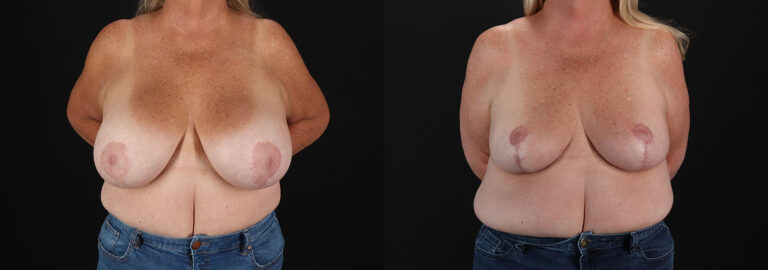 Breast Revision Before and After Photo by Dr. Erika A. Sato in Houston TX