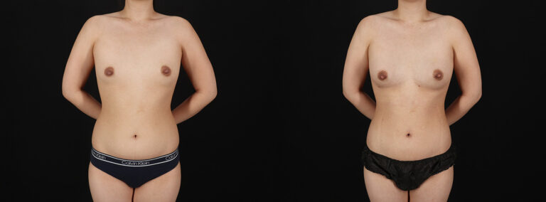 Fat Grafting to the Breast Before and After Photo by Dr. Erika A. Sato in Houston TX