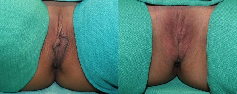 Labiaplasty Before and After Photo by Dr. Erika A. Sato in Houston TX
