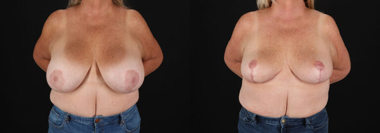Revision Breast Surgery Before and After Photo by Dr. Erika A. Sato in Houston TX