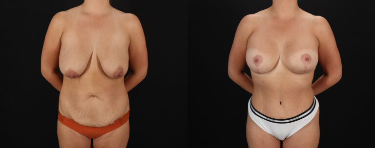 Mommy Makeover Before and After Photo by Dr. Erika A. Sato in Houston TX