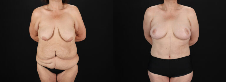 Post Bariatric Surgery (Massive Weight Loss) Before and After Photo by Dr. Erika A. Sato in Houston TX