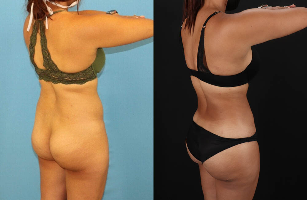 Brazilian Butt Lift case #5118