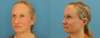 Profound RF Skin Tightening case #6906 slider thumbnail