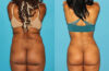 Brazilian Butt Lift case #4675 slider thumbnail