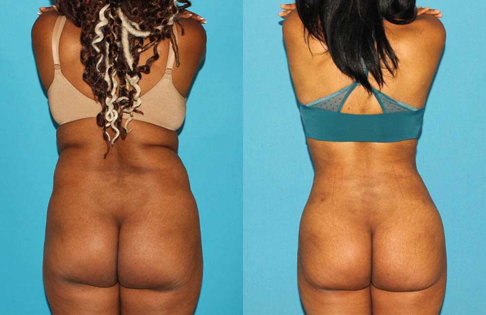 Brazilian Butt Lift case #4675