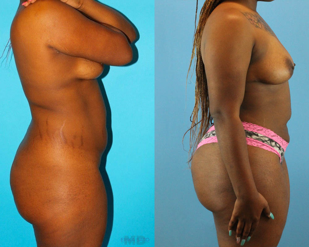 Brazilian Butt Lift case #4583