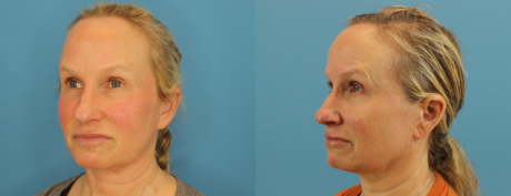 Profound RF Skin Tightening case #6906