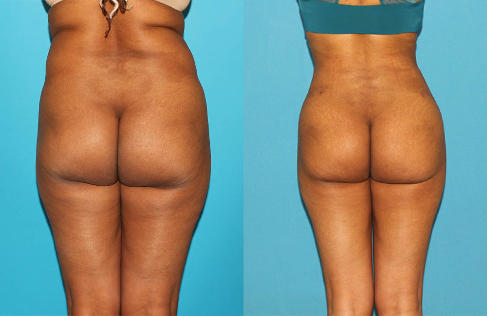 Brazilian Butt Lift case #4675