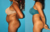 Brazilian Butt Lift case #4675 slider thumbnail