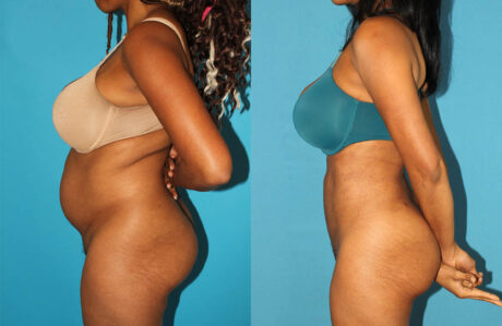 Brazilian Butt Lift case #4675