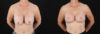 Revision Breast Surgery case #256267 slider thumbnail
