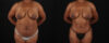 Mommy Makeover case #6688 slider thumbnail