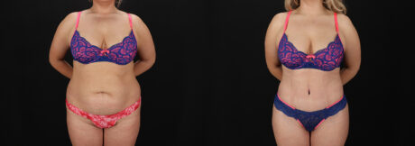 Tummy Tuck case #7775