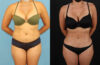 Brazilian Butt Lift case #5118 slider thumbnail