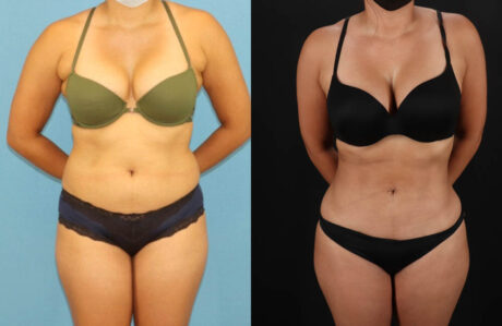 Brazilian Butt Lift case #5118