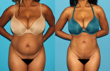 Brazilian Butt Lift case #4675