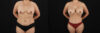 Mommy Makeover case #6687 slider thumbnail