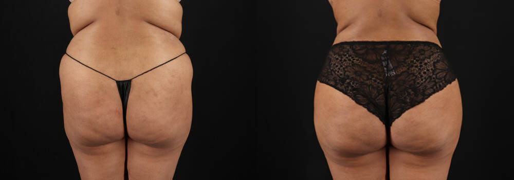Brazilian Butt Lift case #5394
