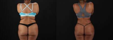 Brazilian Butt Lift case #5513