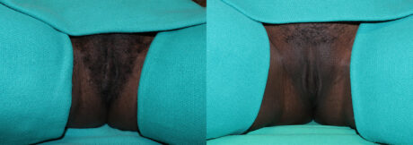 Labiaplasty case #5794