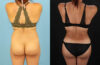 Brazilian Butt Lift case #5118 slider thumbnail