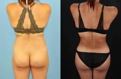 Brazilian Butt Lift case #5118