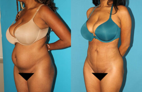 Brazilian Butt Lift case #4675