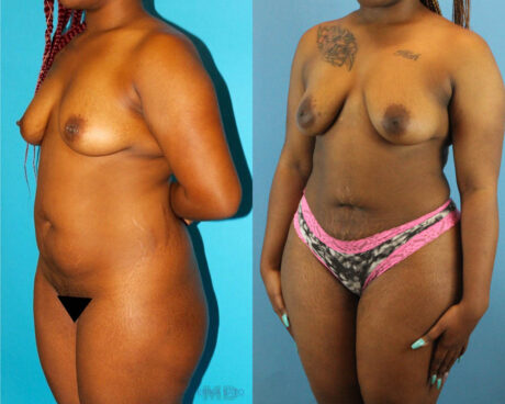 Brazilian Butt Lift case #4583