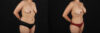 Mommy Makeover case #6687 slider thumbnail