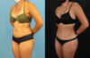 Brazilian Butt Lift case #5118 slider thumbnail