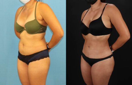 Brazilian Butt Lift case #5118