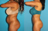 Brazilian Butt Lift case #4675 slider thumbnail