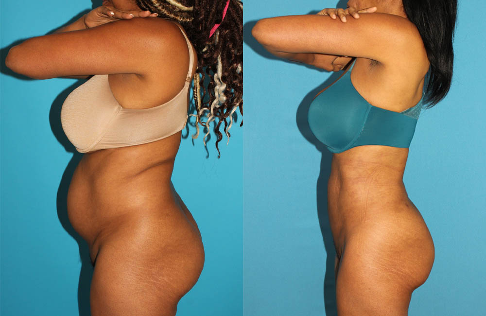 Brazilian Butt Lift case #4675