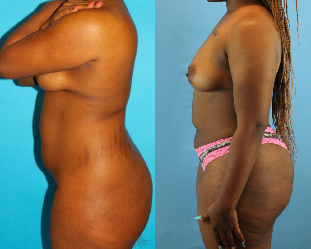 Brazilian Butt Lift case #4583