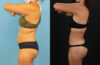 Brazilian Butt Lift case #5118 slider thumbnail