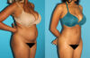 Brazilian Butt Lift case #4675 slider thumbnail