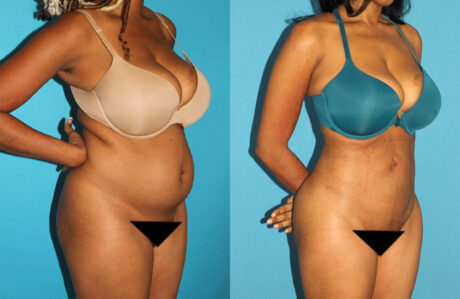 Brazilian Butt Lift case #4675