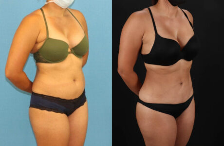 Brazilian Butt Lift case #5118