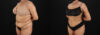 Brazilian Butt Lift case #5394 slider thumbnail