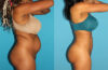 Brazilian Butt Lift case #4675 slider thumbnail