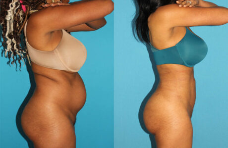 Brazilian Butt Lift case #4675