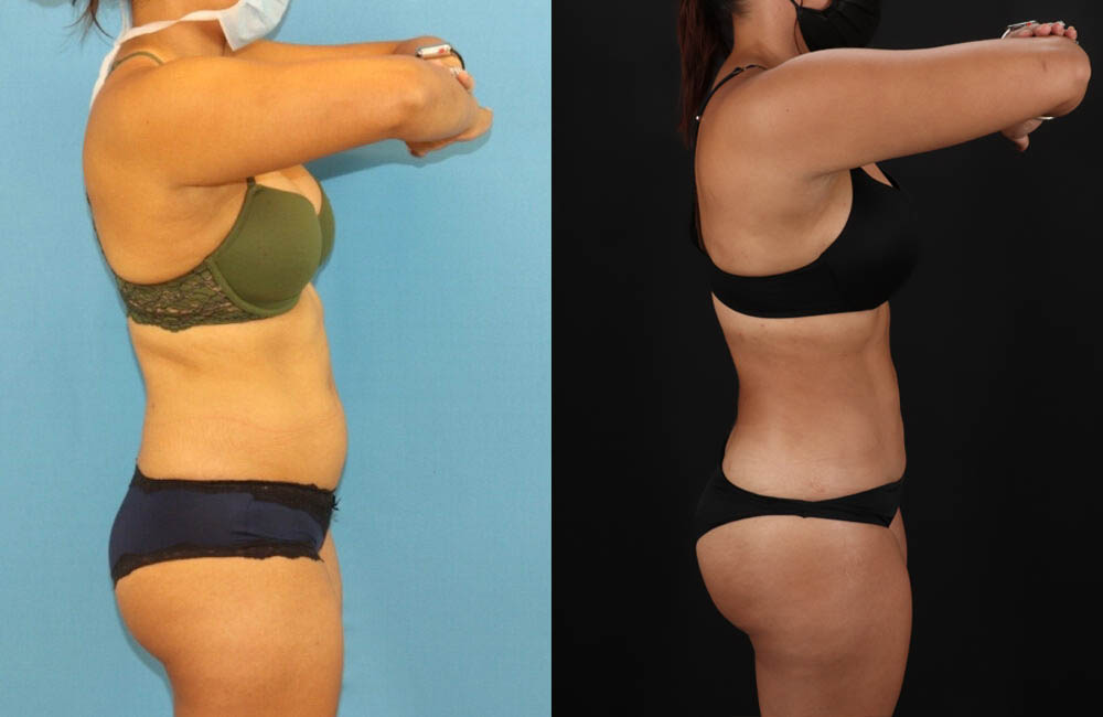 Brazilian Butt Lift case #5118