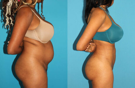 Brazilian Butt Lift case #4675