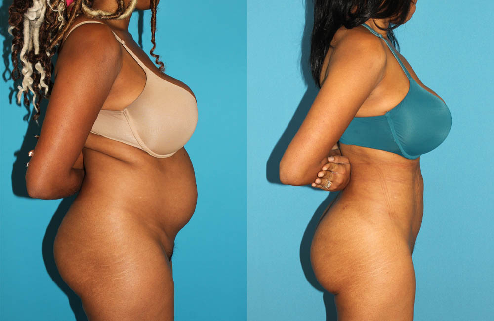 Brazilian Butt Lift case #4675